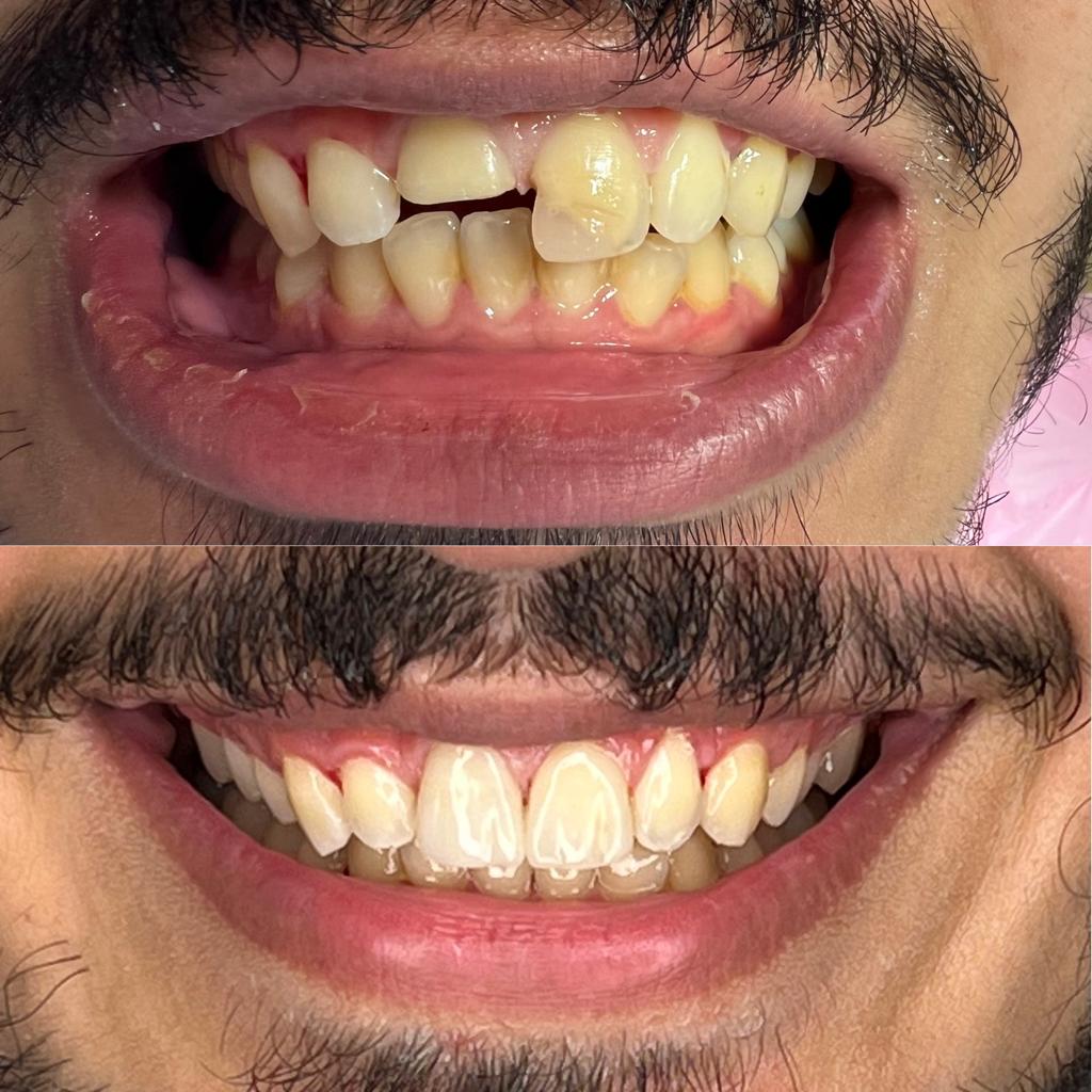 کامپوزیت دندان الهیه تهران