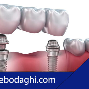 مواد ایمپلنت دندان چیست ؟