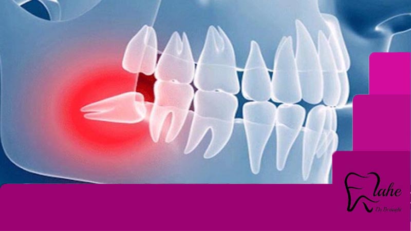کشیدن دندان عقل نیمه نهفته