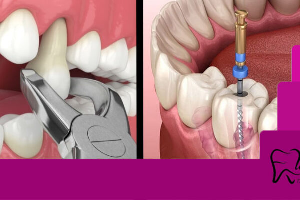 کشیدن دندان بهتر است یا عصب کشی
