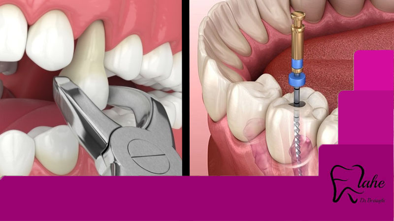 کشیدن دندان بهتر است یا عصب کشی