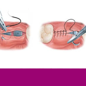 کشیدن بخیه ایمپلنت دندان