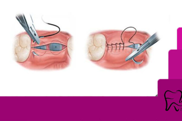 کشیدن بخیه ایمپلنت دندان