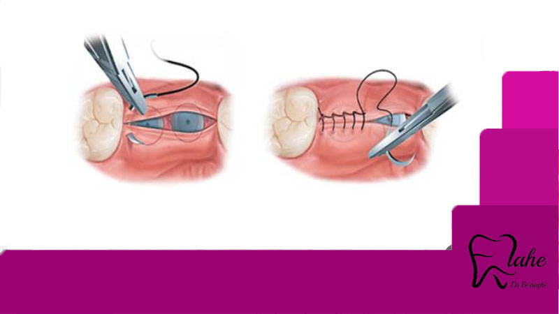 کشیدن بخیه ایمپلنت دندان