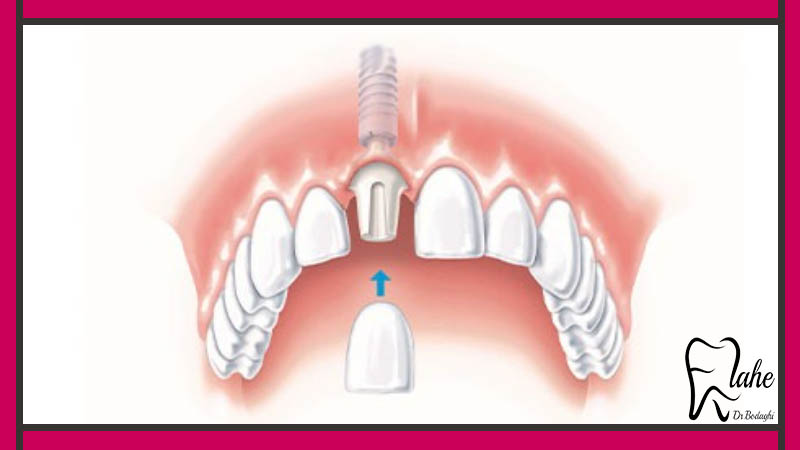کاشت ایمپلنت بدون جراحی