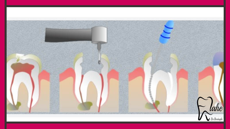 کارهایی که بعد از عصب کشی دندان باید انجام داد